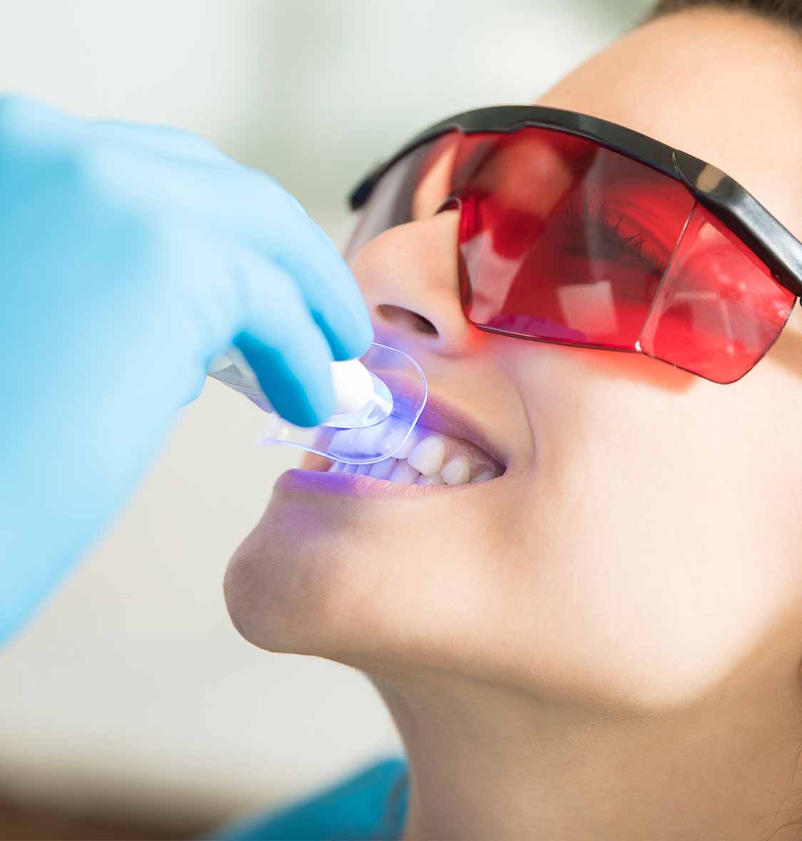 Clareamento Dentário