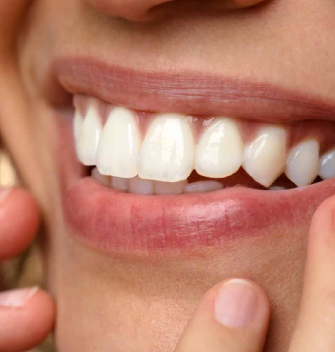 Lentes de contato dental e facetas 2